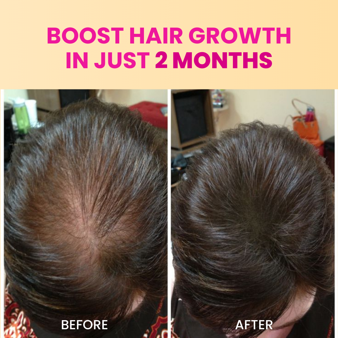 Advanced Hair Growth Oil | Onion & Black Seed Hair Oil | 200 ml